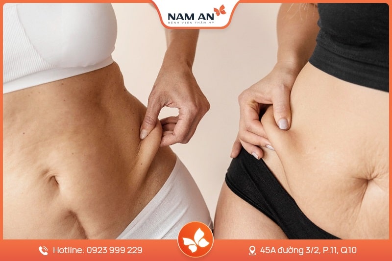 Phẫu Thuật Tạo Hình Thành Bụng Chuẩn Y Khoa Tại Nam An (8)