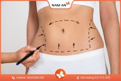 Phẫu Thuật Tạo Hình Thành Bụng Chuẩn Y Khoa Tại Nam An