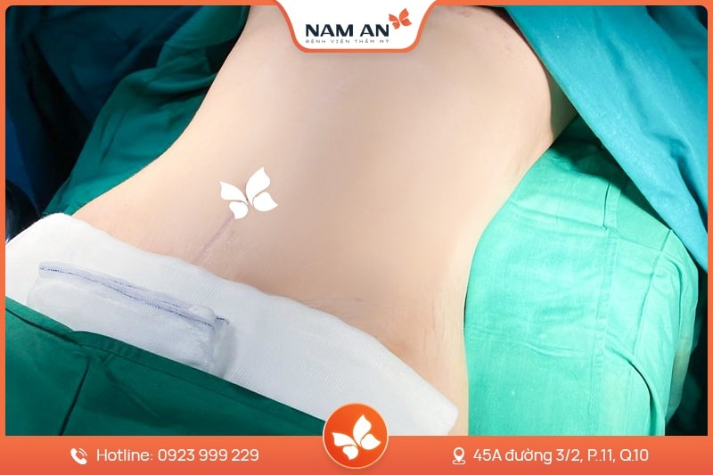 Phẫu Thuật Tạo Hình Thành Bụng Chuẩn Y Khoa Tại Nam An