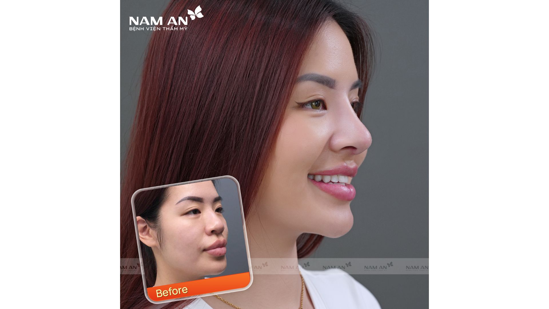 Phẫu Thuật Thu Nhỏ Đầu Mũi Thon Gọn Tại Nam An (1)