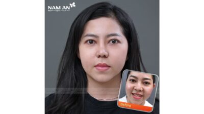 Phẫu Thuật Thu Nhỏ Đầu Mũi Thon Gọn Tại Nam An