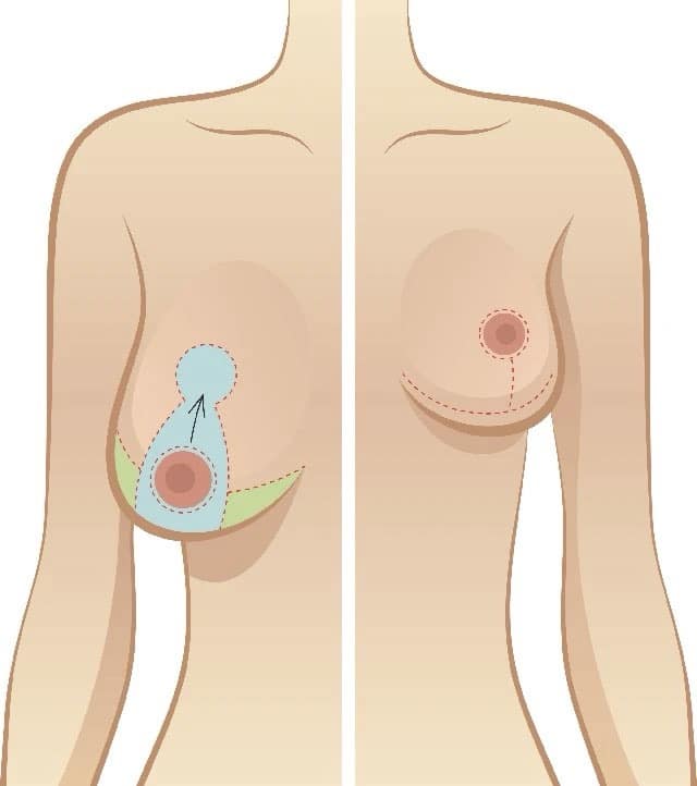 Phẫu Thuật Thu Nhỏ Ngực Phì Đại An Toàn Tại Nam An