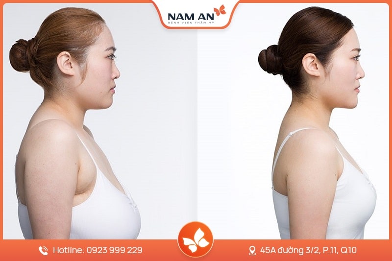 Phẫu Thuật Thu Nhỏ Ngực Quá Khổ - Bệnh Viện Nam An (4)