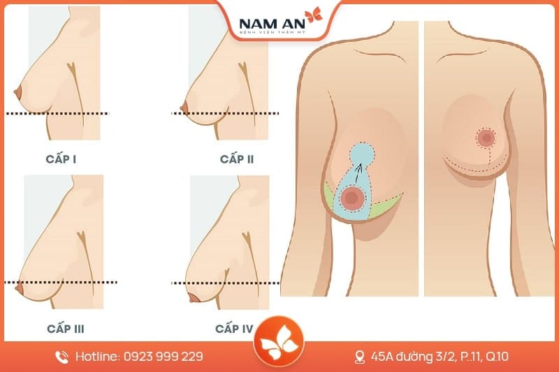 Phẫu Thuật Treo Ngực Sa Trễ - Lấy Lại Vòng 1 Săn Chắc (3)