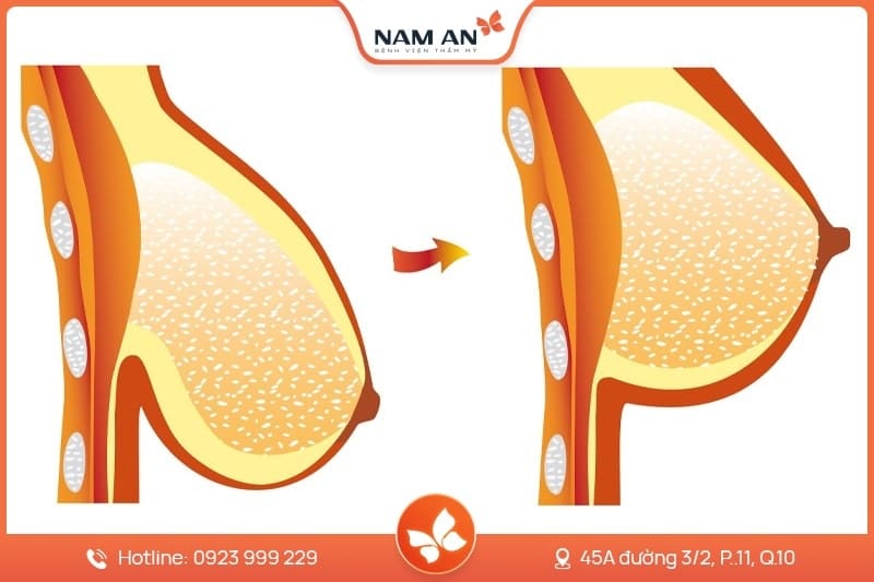 Phẫu Thuật Treo Ngực Sa Trễ - Lấy Lại Vòng 1 Săn Chắc (4)