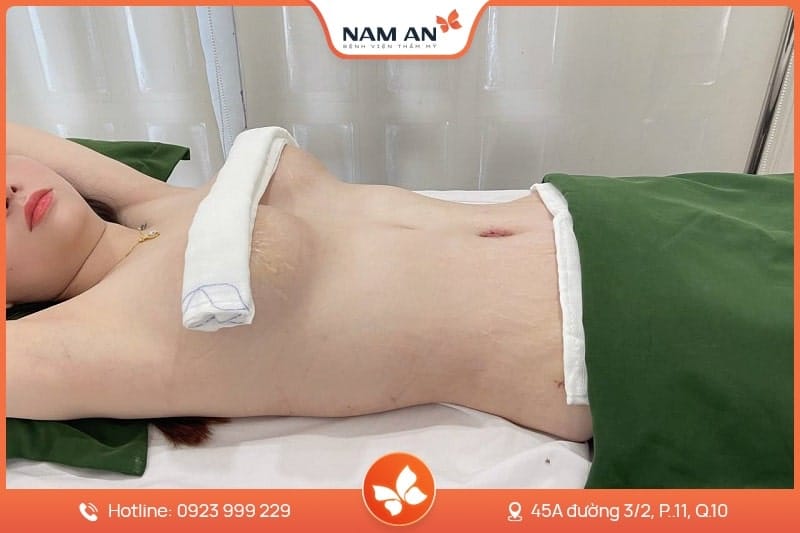Phẫu Thuật Treo Ngực Sa Trễ - Lấy Lại Vòng 1 Săn Chắc (5)