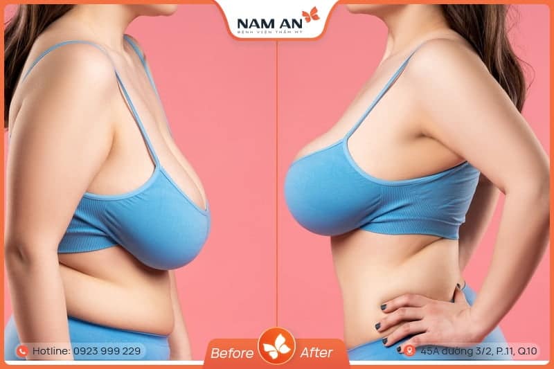 Phẫu Thuật Treo Ngực Sa Trễ - Lấy Lại Vòng 1 Săn Chắc