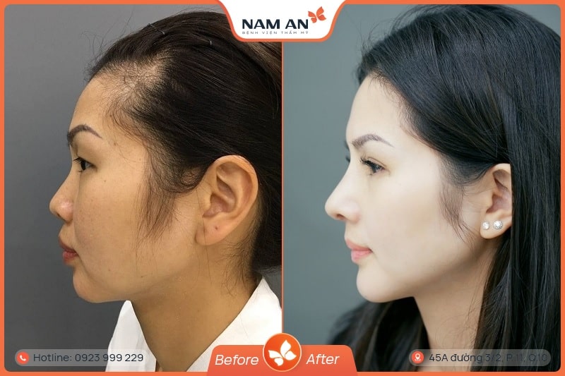 Phẫu Thuật Trượt Cằm Tự Thân Đẹp Tự Nhiên Tại Nam An (1)
