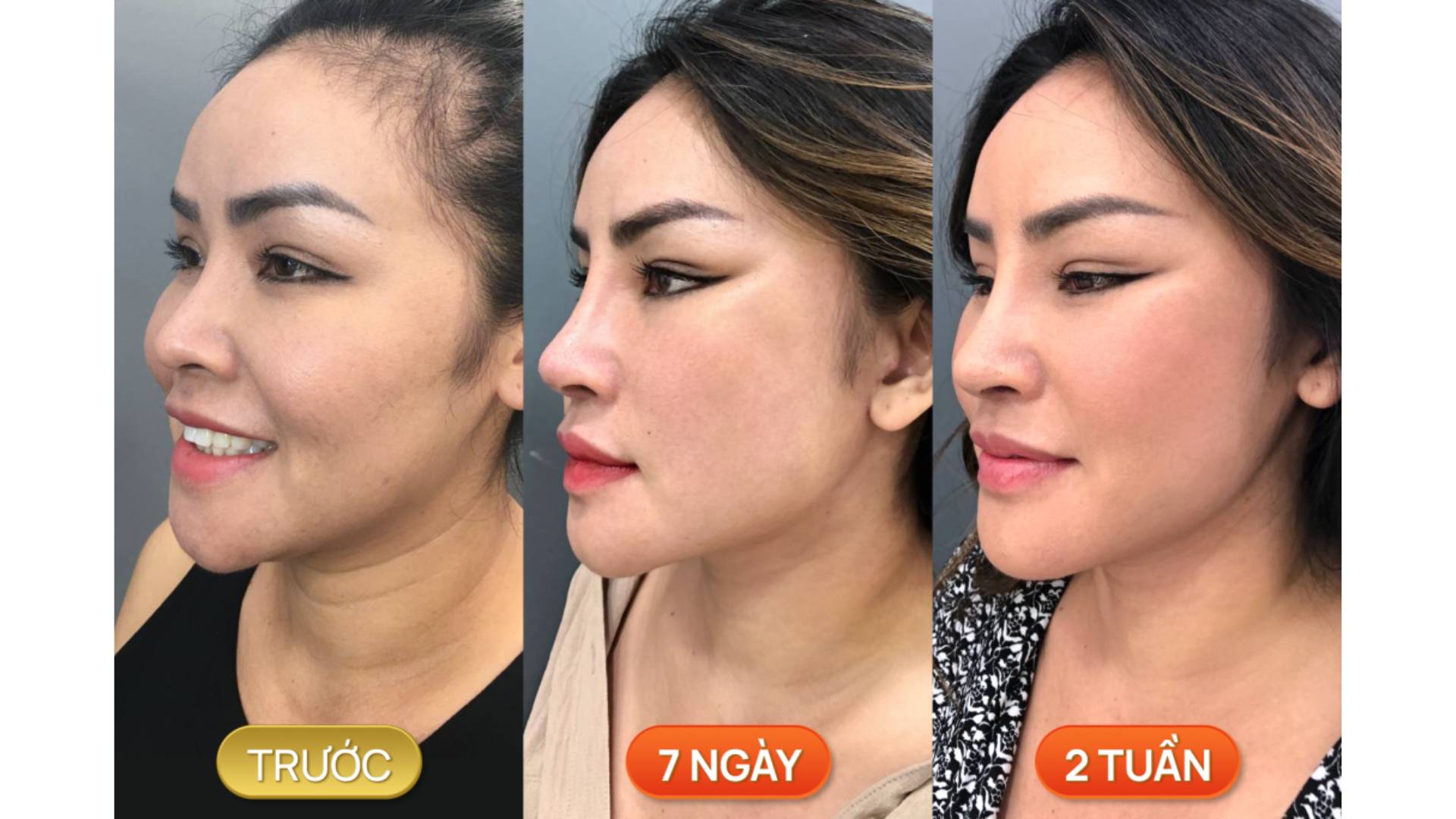 Phương Pháp Khắc Phục Lão Hóa Da Vùng Cổ Hiệu Quả Nhất