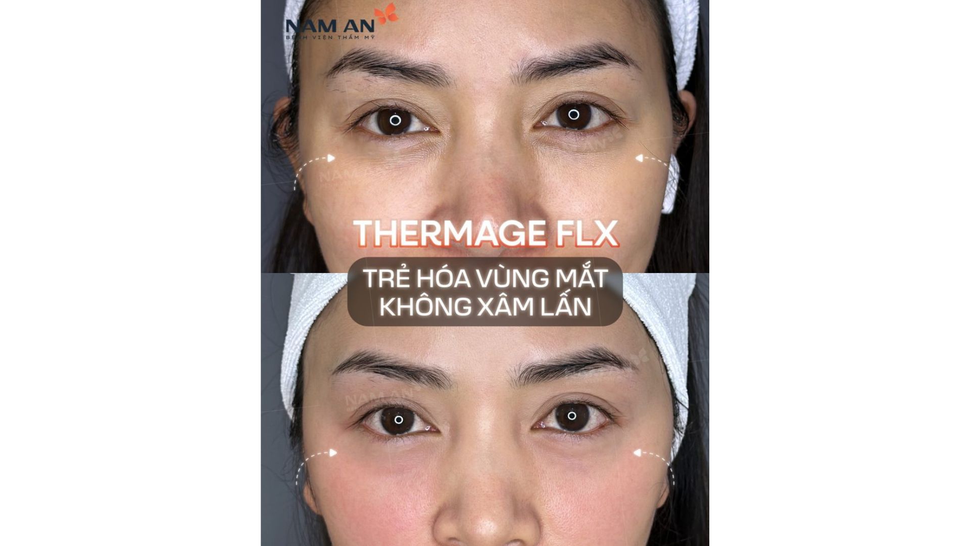 Phương Pháp Trẻ Hóa Không Phẫu Thuật Tại Nam An (1)