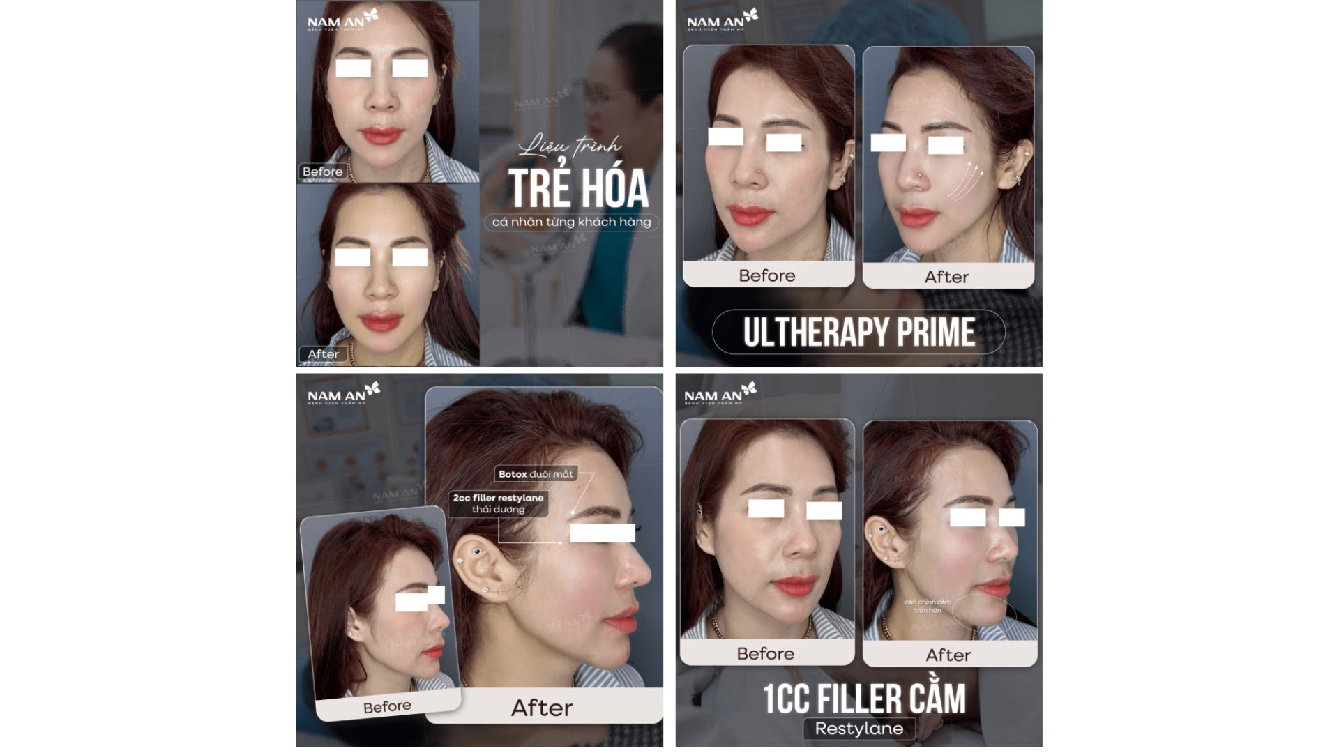 Phương Pháp Trẻ Hóa Không Phẫu Thuật Tại Nam An (10)