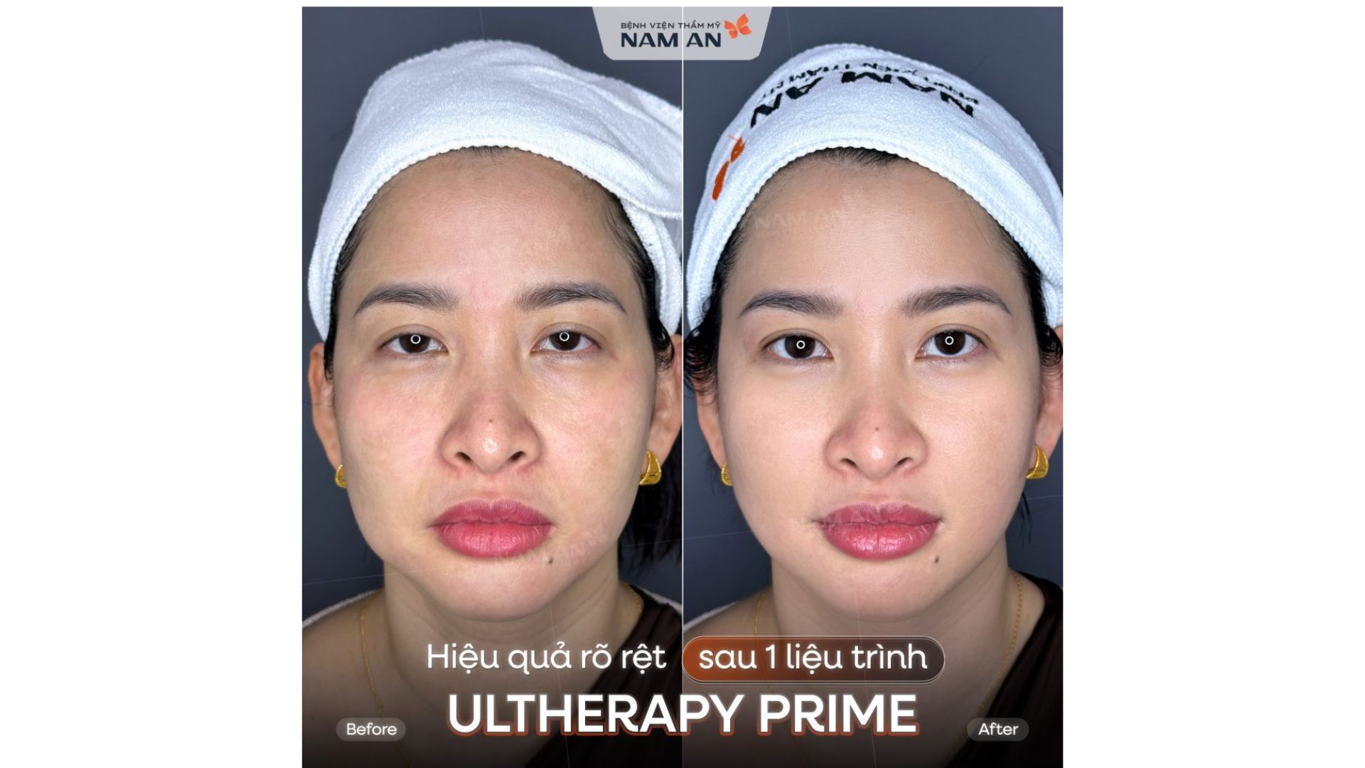 Phương Pháp Trẻ Hóa Không Phẫu Thuật Tại Nam An (11)