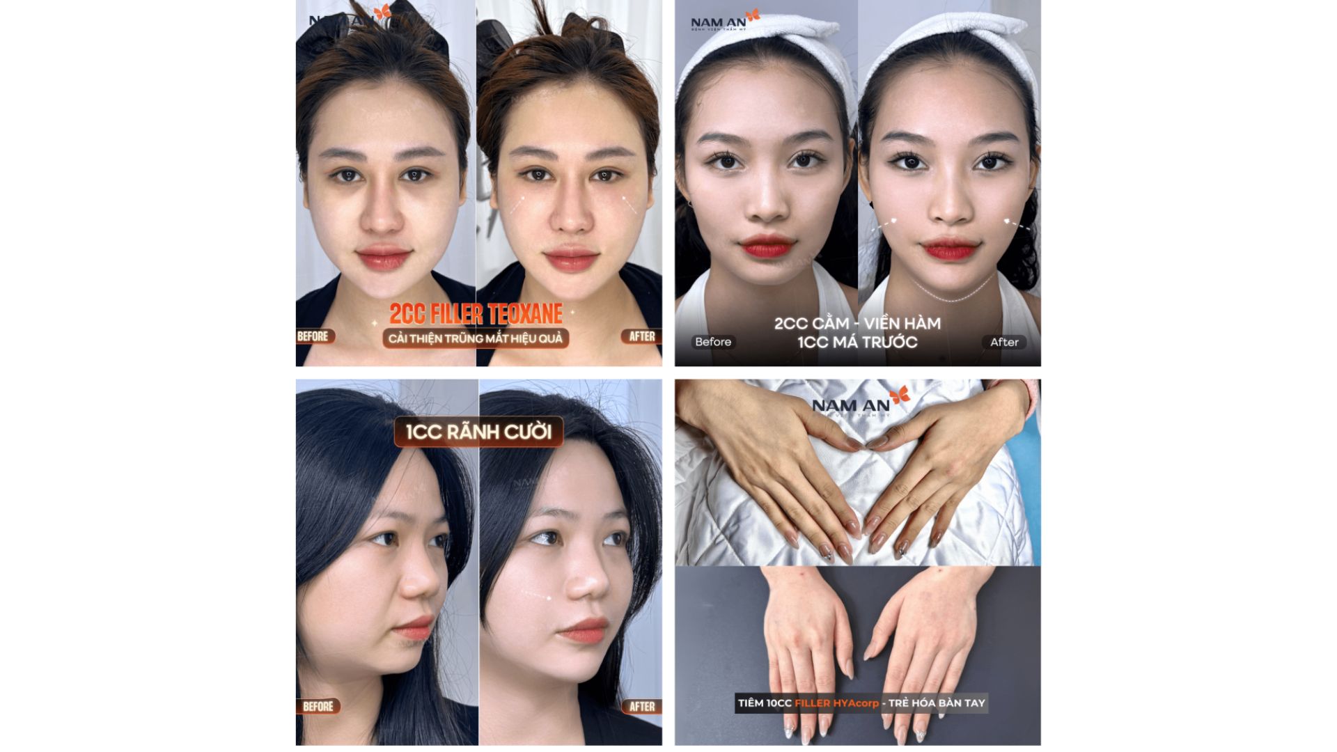 Phương Pháp Trẻ Hóa Không Phẫu Thuật Tại Nam An (5)