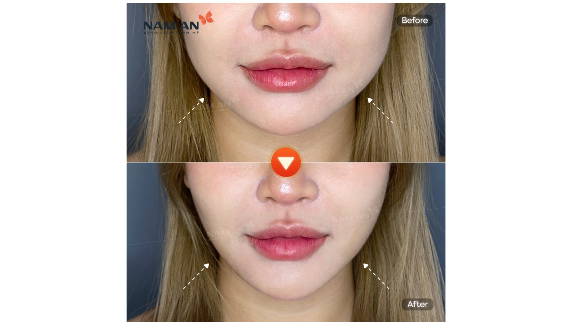Phương Pháp Trẻ Hóa Không Phẫu Thuật Tại Nam An (6)
