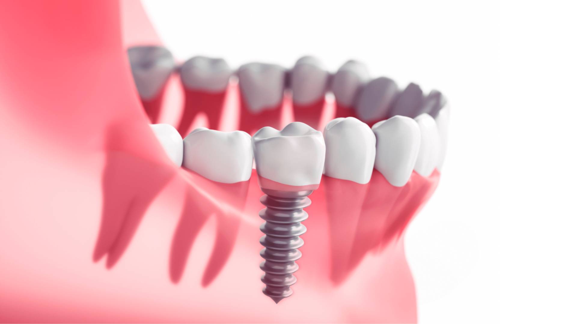 Sau Khi Nhổ Răng Bao Lâu Thì Cấy Ghép Implant Được (1)