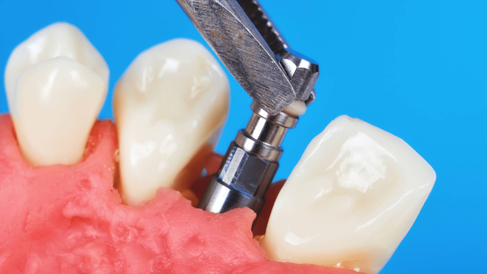 Sau Khi Nhổ Răng Bao Lâu Thì Cấy Ghép Implant Được (2)