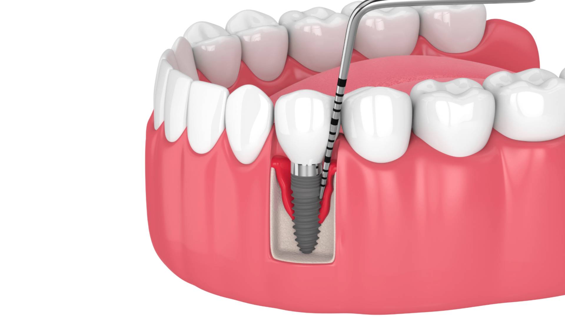 Sau Khi Nhổ Răng Bao Lâu Thì Cấy Ghép Implant Được (5)