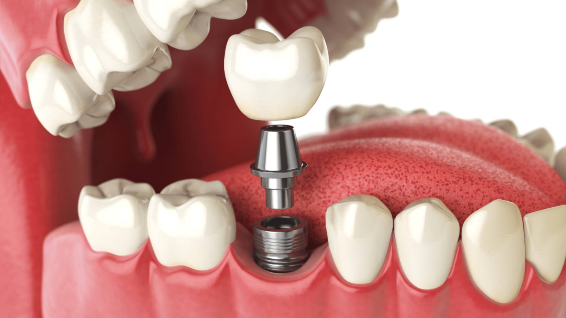 Sau Khi Nhổ Răng Bao Lâu Thì Cấy Ghép Implant Được (6)