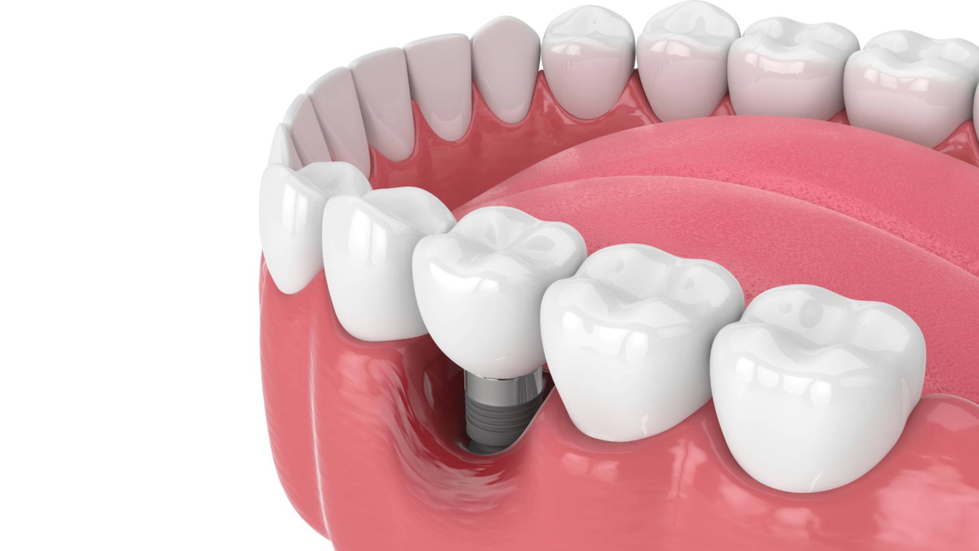 Sau Khi Nhổ Răng Bao Lâu Thì Cấy Ghép Implant Được (7)