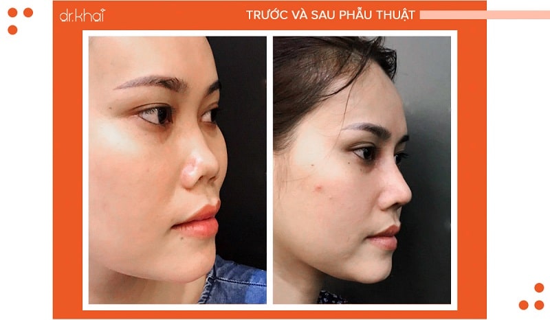 THÀNH CÔNG SAU 10 NĂM VỚI 5 LẦN PHẪU THUẬT NÂNG MŨI