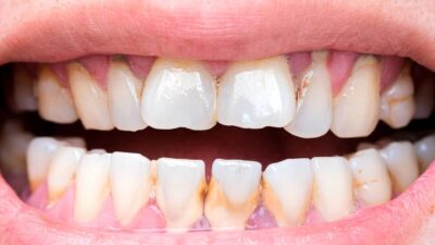 Tác Hại Của Việc Không Cạo Vôi Răng Dẫn Đến Viêm Nha Chu