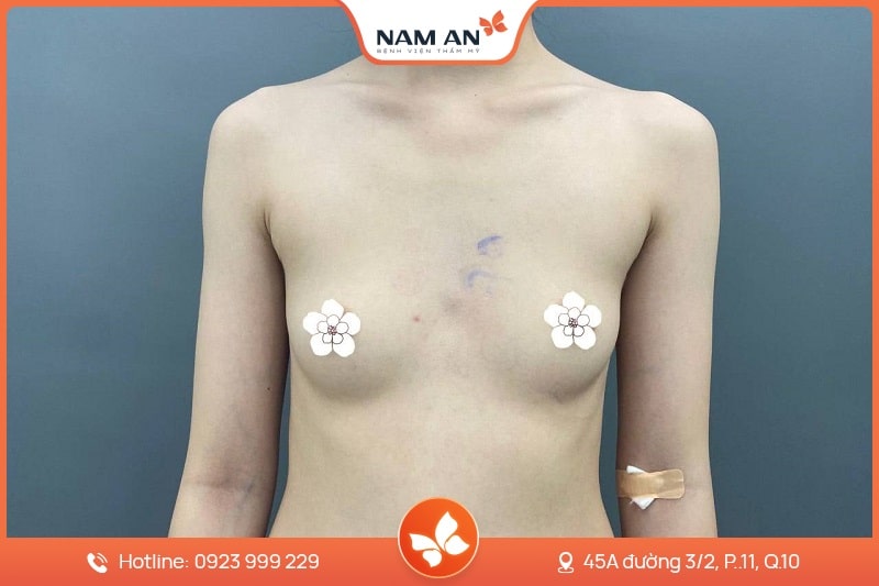 Thu Gọn Quầng Vú Tỉ Lệ Vàng, Không Lộ Sẹo Tại Nam An (2)