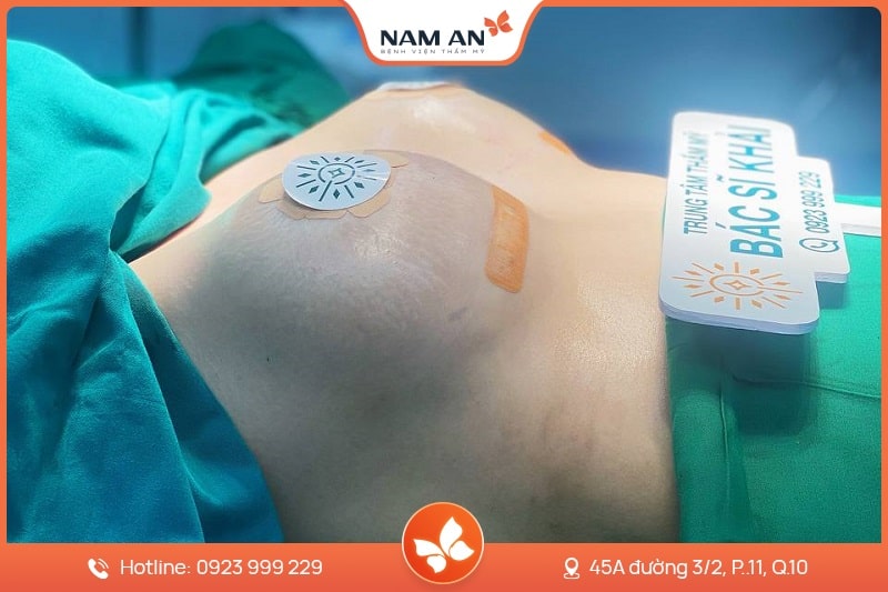 Thu Gọn Quầng Vú Tỉ Lệ Vàng, Không Lộ Sẹo Tại Nam An (6)