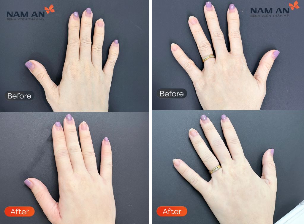 Tiêm Filler Có An Toàn Không Vì Sao Lại Được Ưa Chuộng (1)