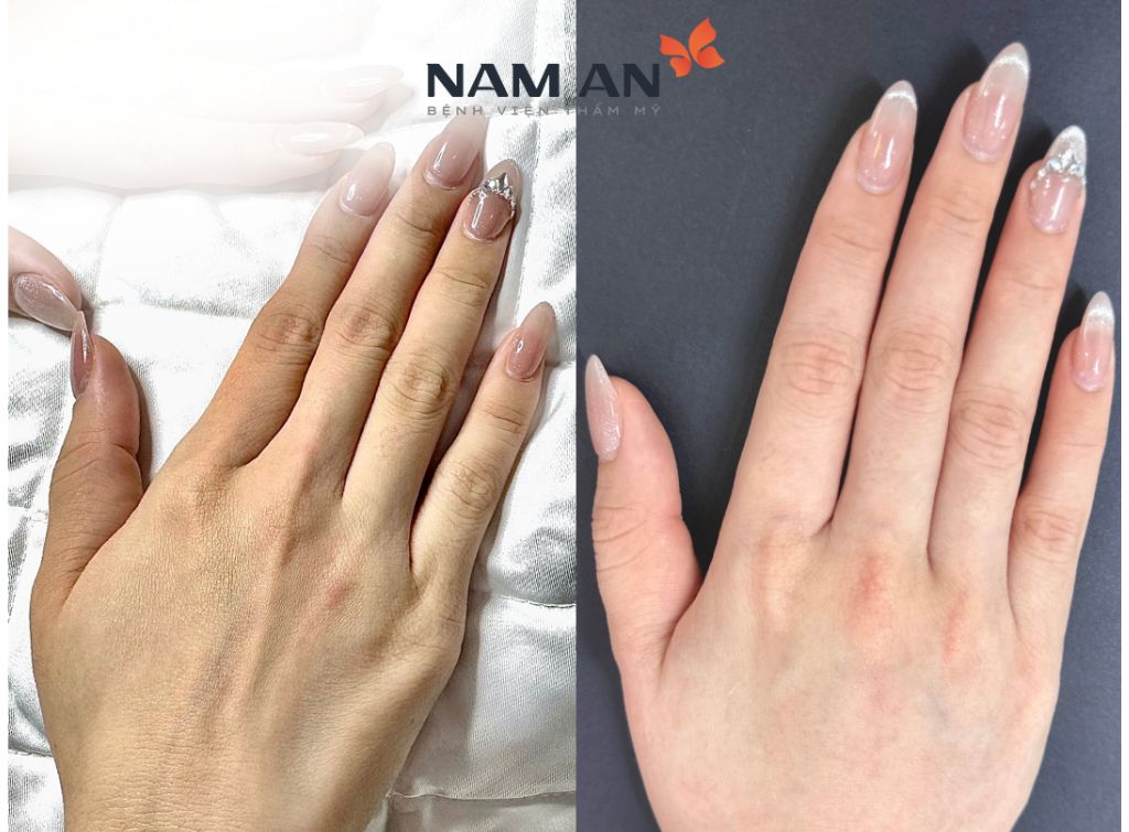 Tiêm Filler Có An Toàn Không Vì Sao Lại Được Ưa Chuộng (2)