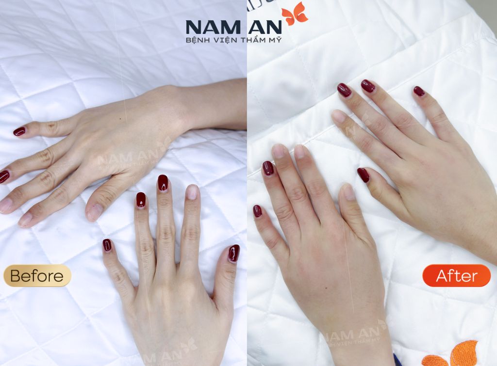 Tiêm Filler Có An Toàn Không Vì Sao Lại Được Ưa Chuộng (3)