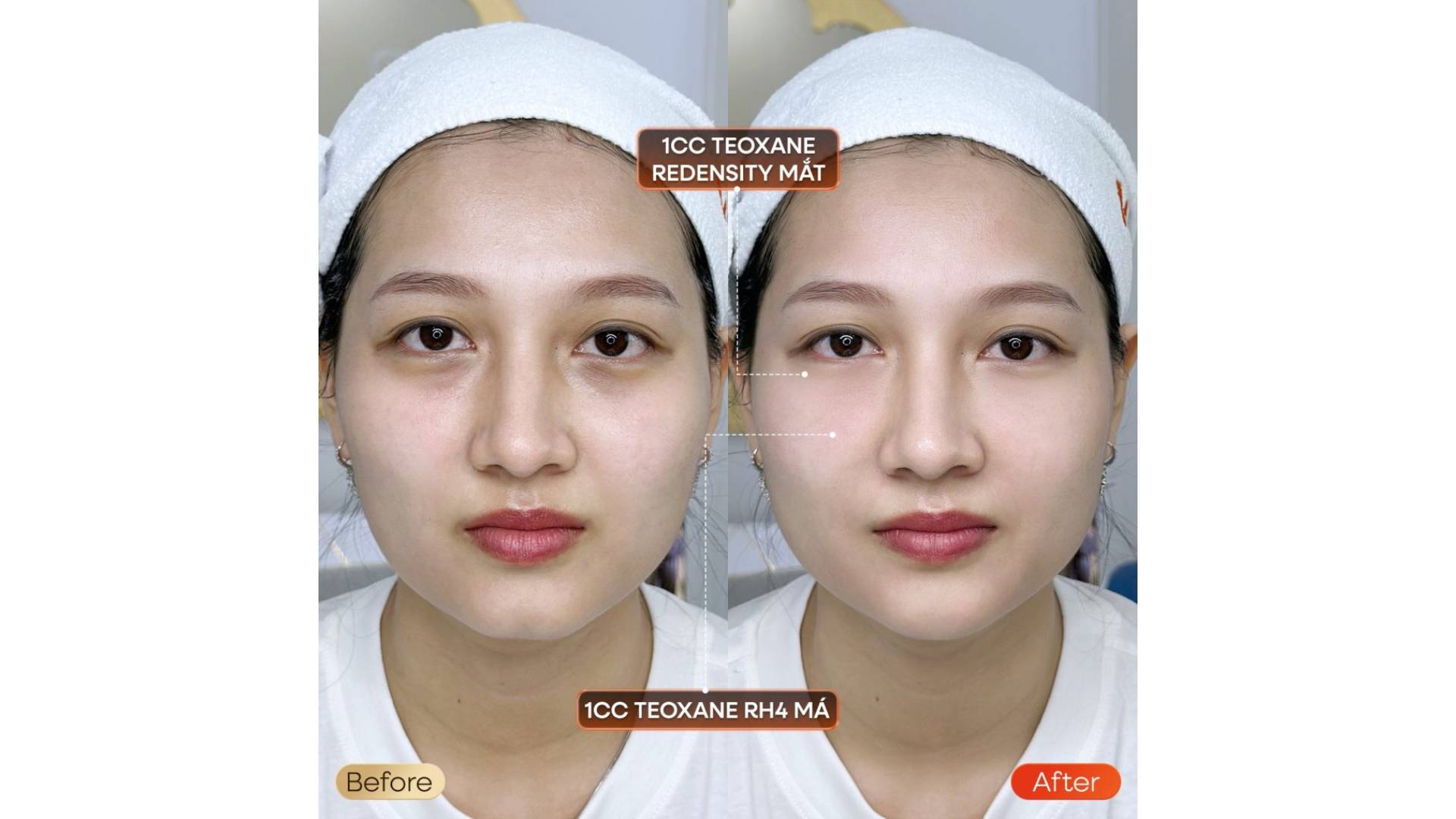 Tiêm Filler Có An Toàn Không Vì Sao Lại Được Ưa Chuộng (4)
