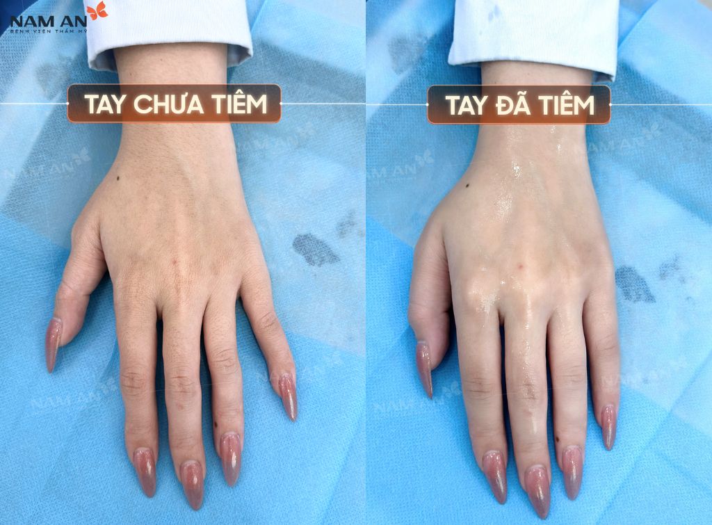 Tiêm Filler Có An Toàn Không Vì Sao Lại Được Ưa Chuộng (7)