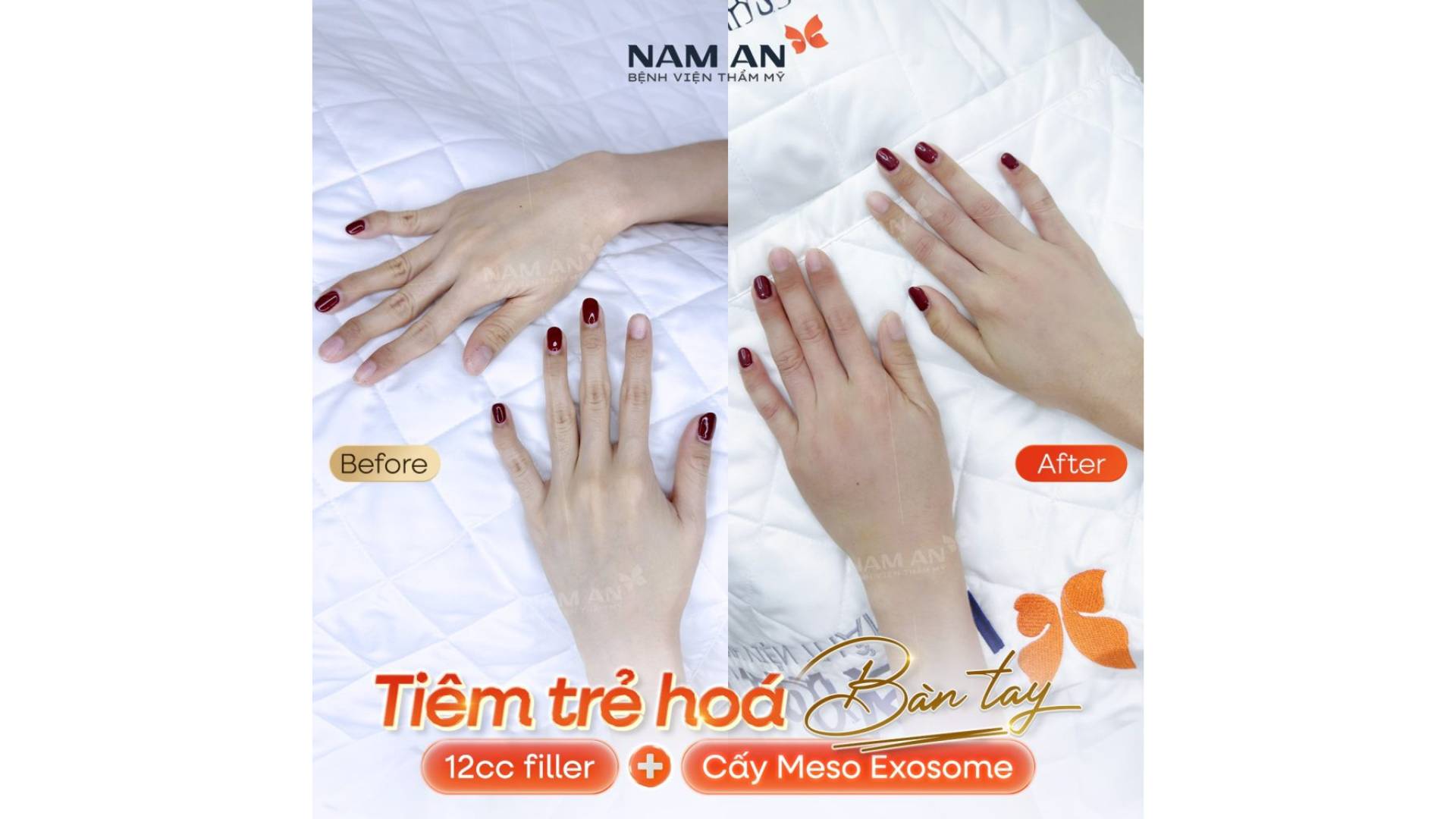 Tiêm Filler Có An Toàn Không Vì Sao Lại Được Ưa Chuộng (7)