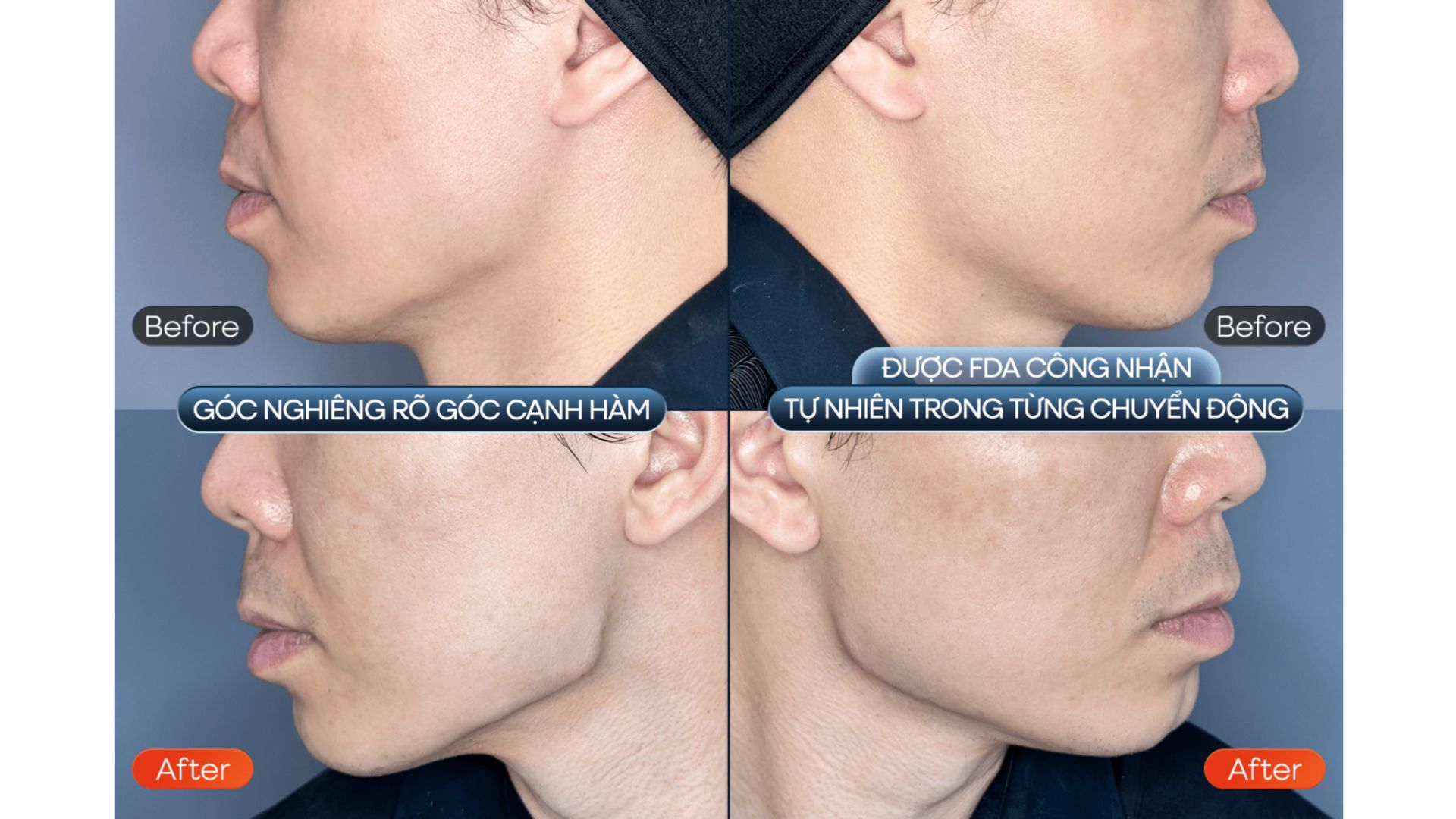 Tiêm Filler Teosyal RHA Tạo Khối Viền Hàm Tại Nam An (3)
