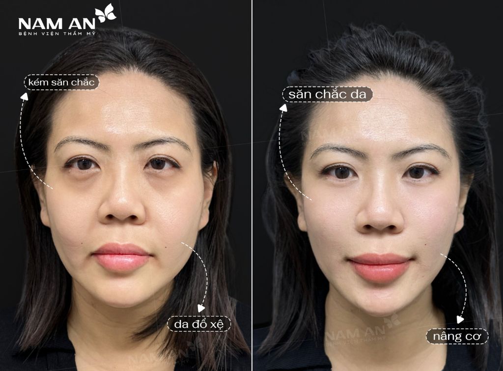 Top 5 Dịch Vụ Chăm Sóc Da Đón Tết Rạng Rỡ Tại Nam An (2)