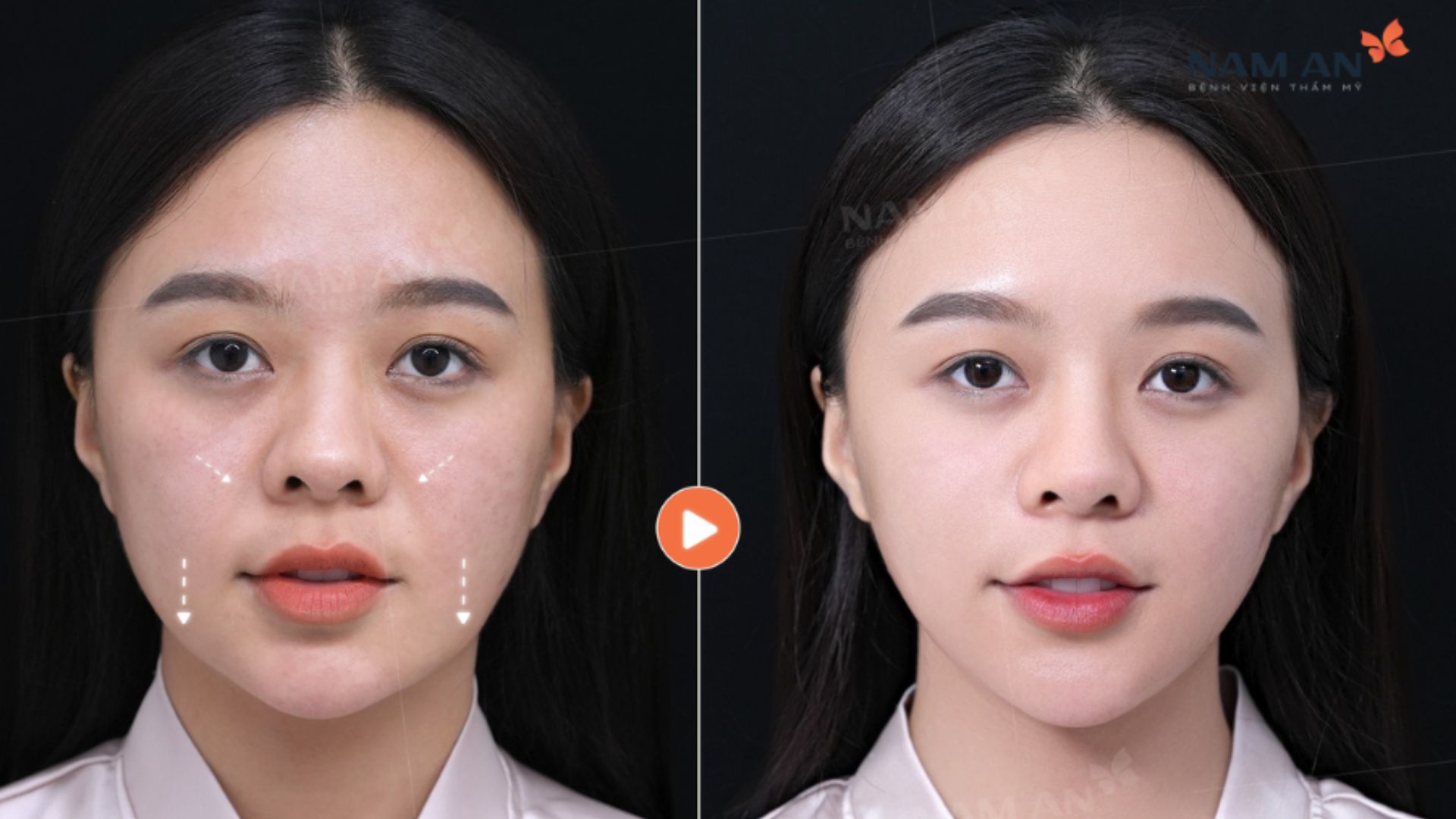 Top 5 Dịch Vụ Thẩm Mỹ Nên Làm Trước Tết Tại Nam An (4)
