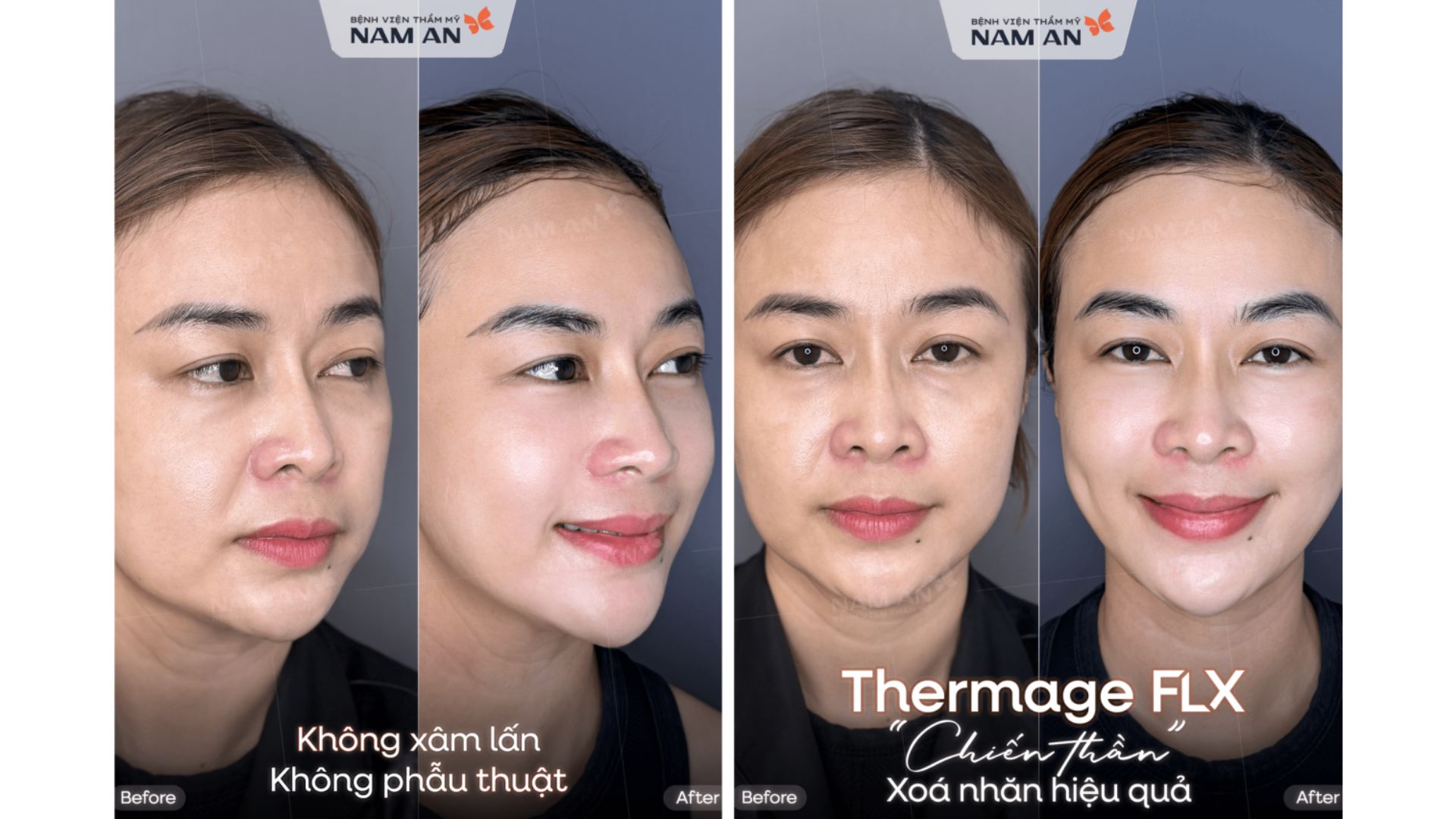 Trẻ Hóa Da Với Thermage FLX Tại BVTM Nam An (10)
