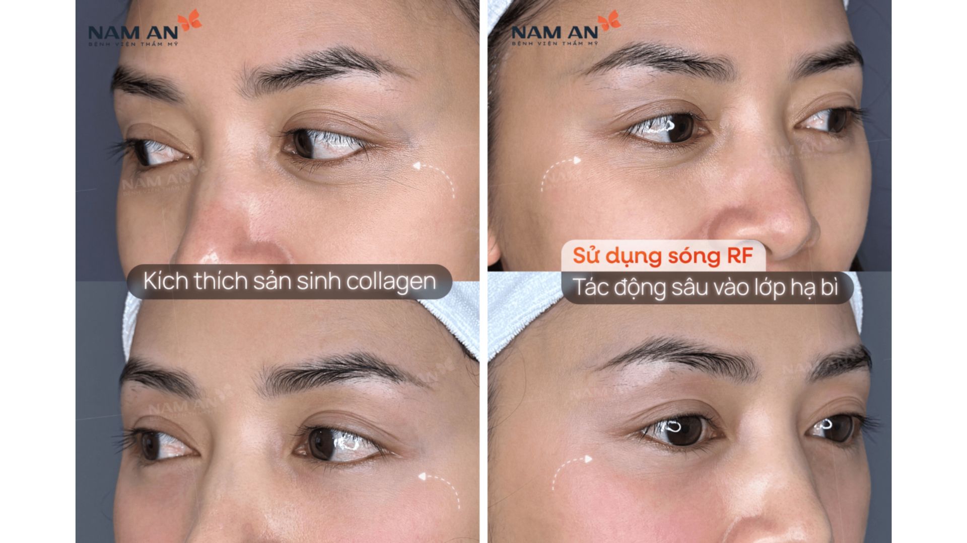 Trẻ Hóa Da Với Thermage FLX Tại BVTM Nam An (2)