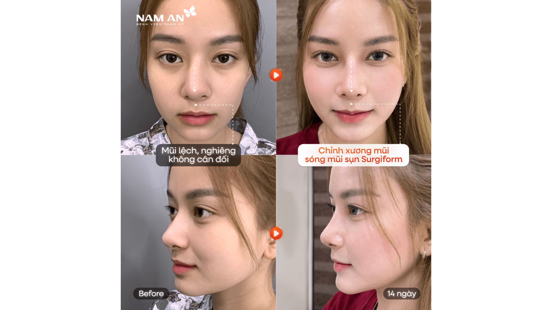 Xu Hướng Nâng Mũi Tự Nhiên Và An Toàn Tại Nam An (2)