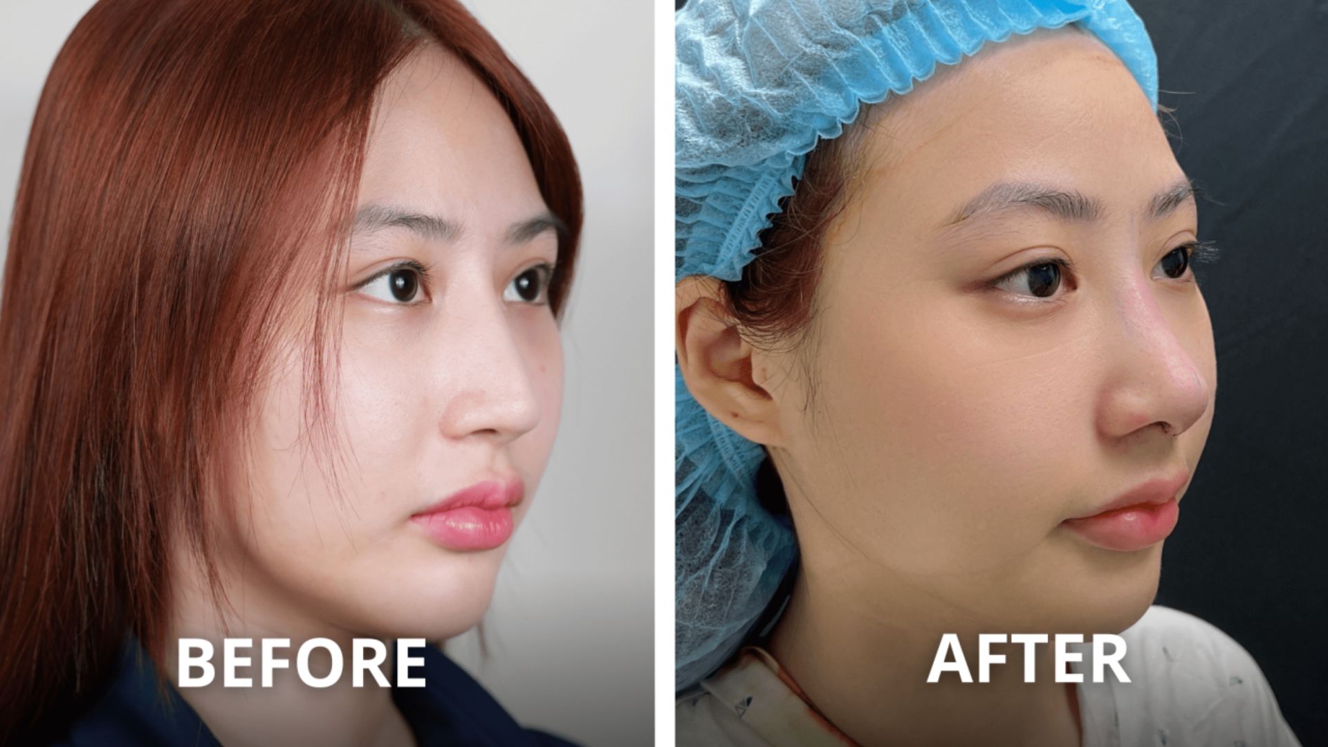 Xu Hướng Nâng Mũi Tự Nhiên Và An Toàn Tại Nam An (3)