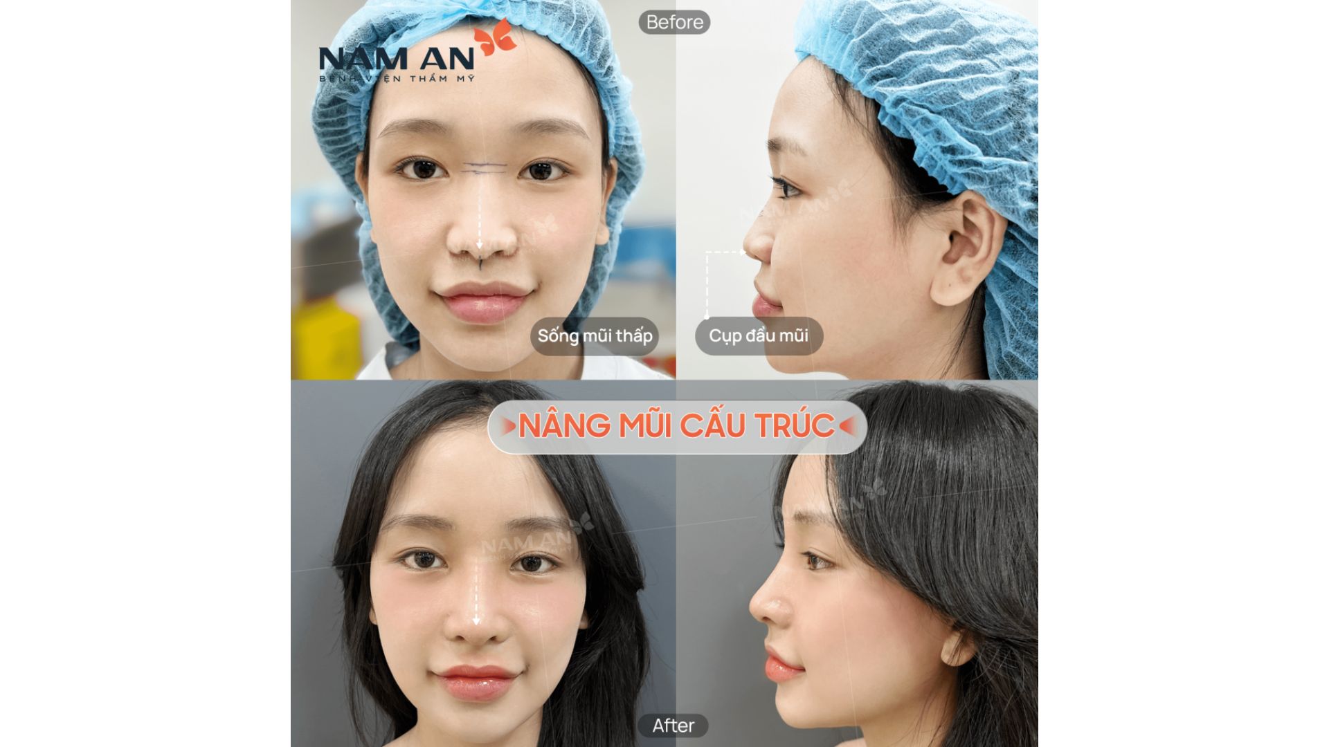 Xu Hướng Nâng Mũi Tự Nhiên Và An Toàn Tại Nam An (4)