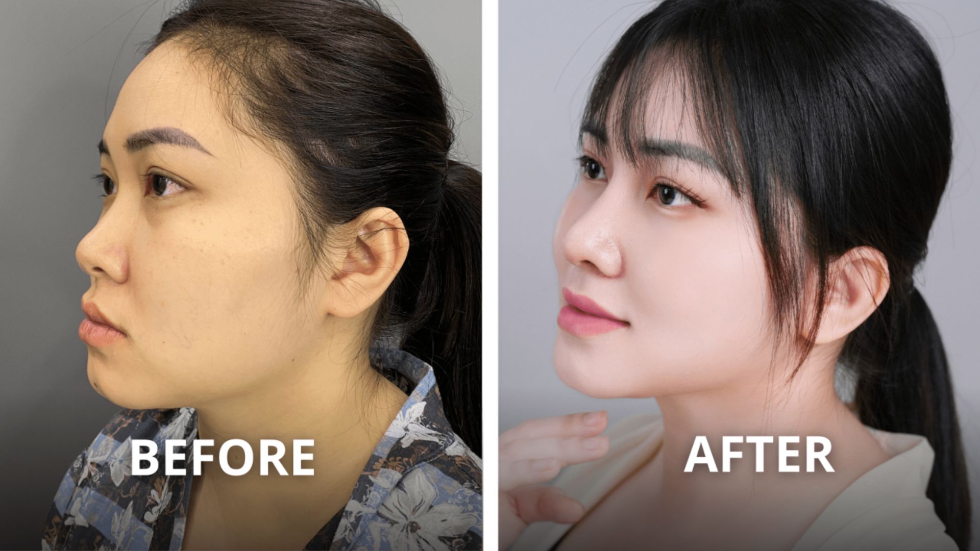 Xu Hướng Nâng Mũi Tự Nhiên Và An Toàn Tại Nam An (5)