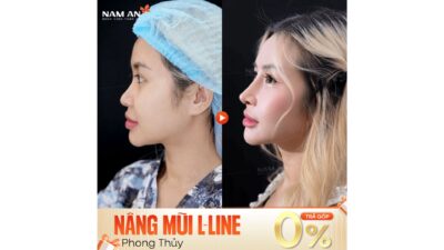 Xu Hướng Nâng Mũi Tự Nhiên Và An Toàn Tại Nam An