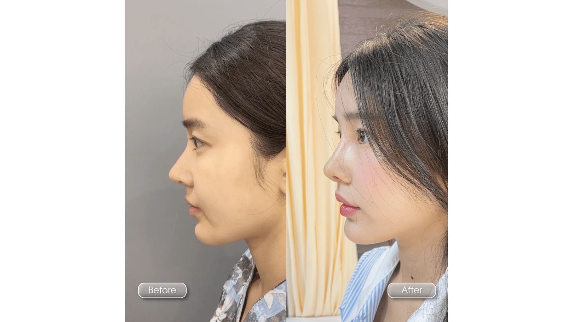Xu Hướng Nâng Mũi Tự Nhiên Và An Toàn Tại Nam An (8)