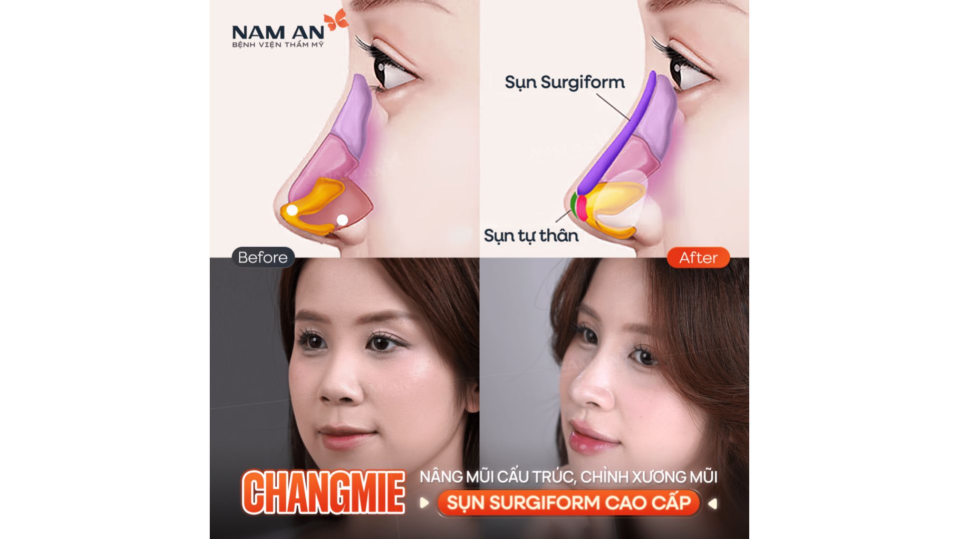 Xu Hướng Nâng Mũi Tự Nhiên Và An Toàn Tại Nam An