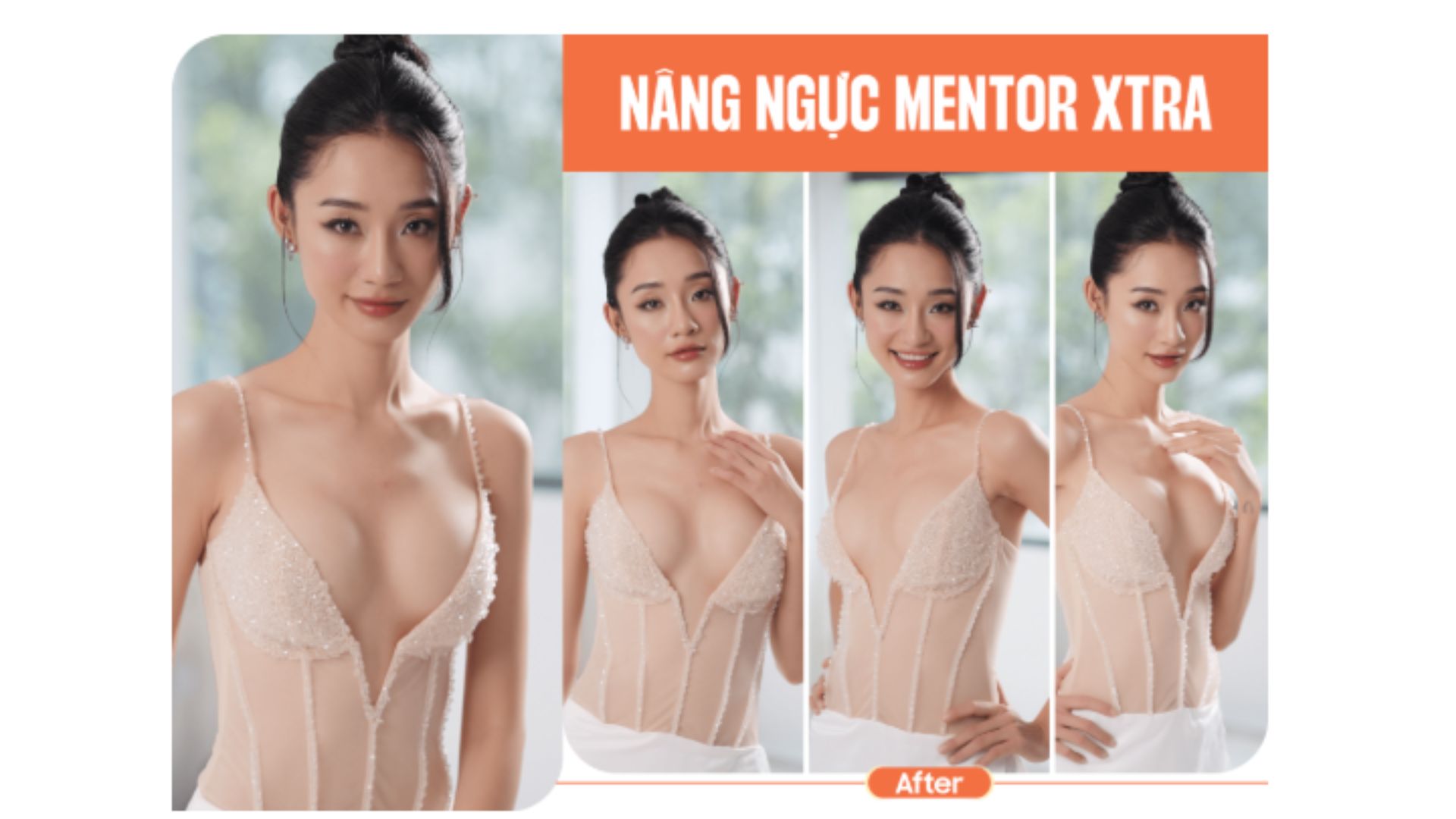 nâng ngực bệnh viện nam an
