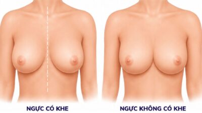 Ngực không có khe: vì sao không tạo rãnh giữa?