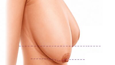 Ngực nhão là gì? Dấu hiệu nhận biết ngực bị nhão