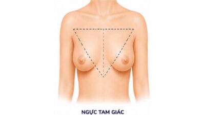 Ngực tam giác nên nâng ngực các loại túi ngực nào?